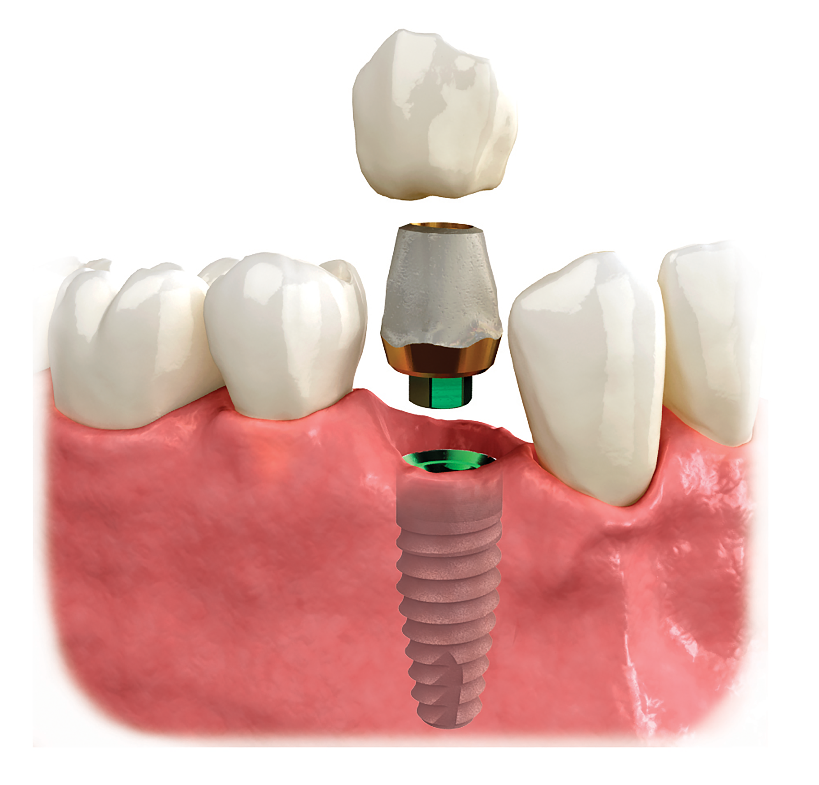 Missing tooth to implant dental implant visual