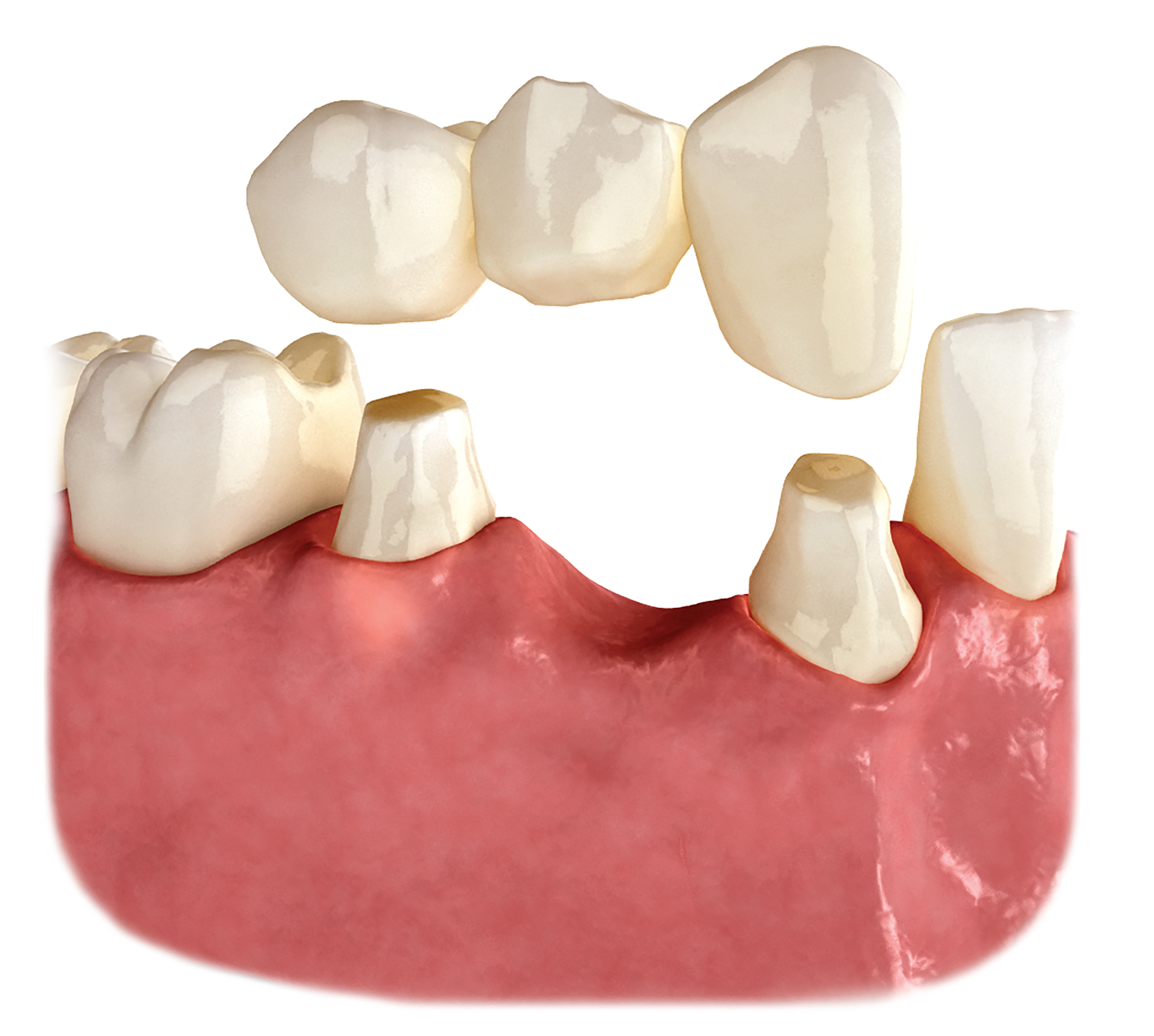 Bridge vs implant dental implant visual