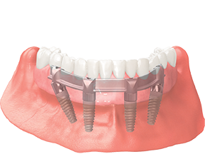 All-on-X concept dental implant visual