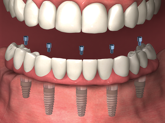 Full arch planning dental implant visual