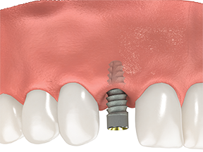 Immediate Dental Implants dental service visual card
