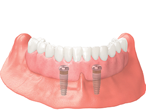 Implant denture locator dental implant visual