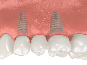 Multiple missing teeth dental implant visual